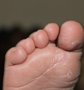 Athlete's Foot (Tinea Pedis)