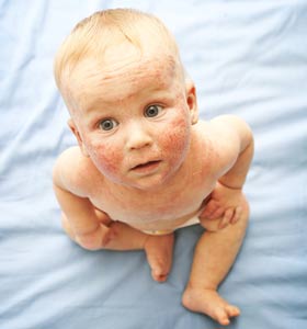 Atopic dermatitis (Eczema)