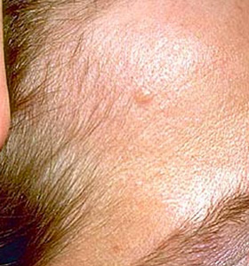 Basal Cell Carcinoma