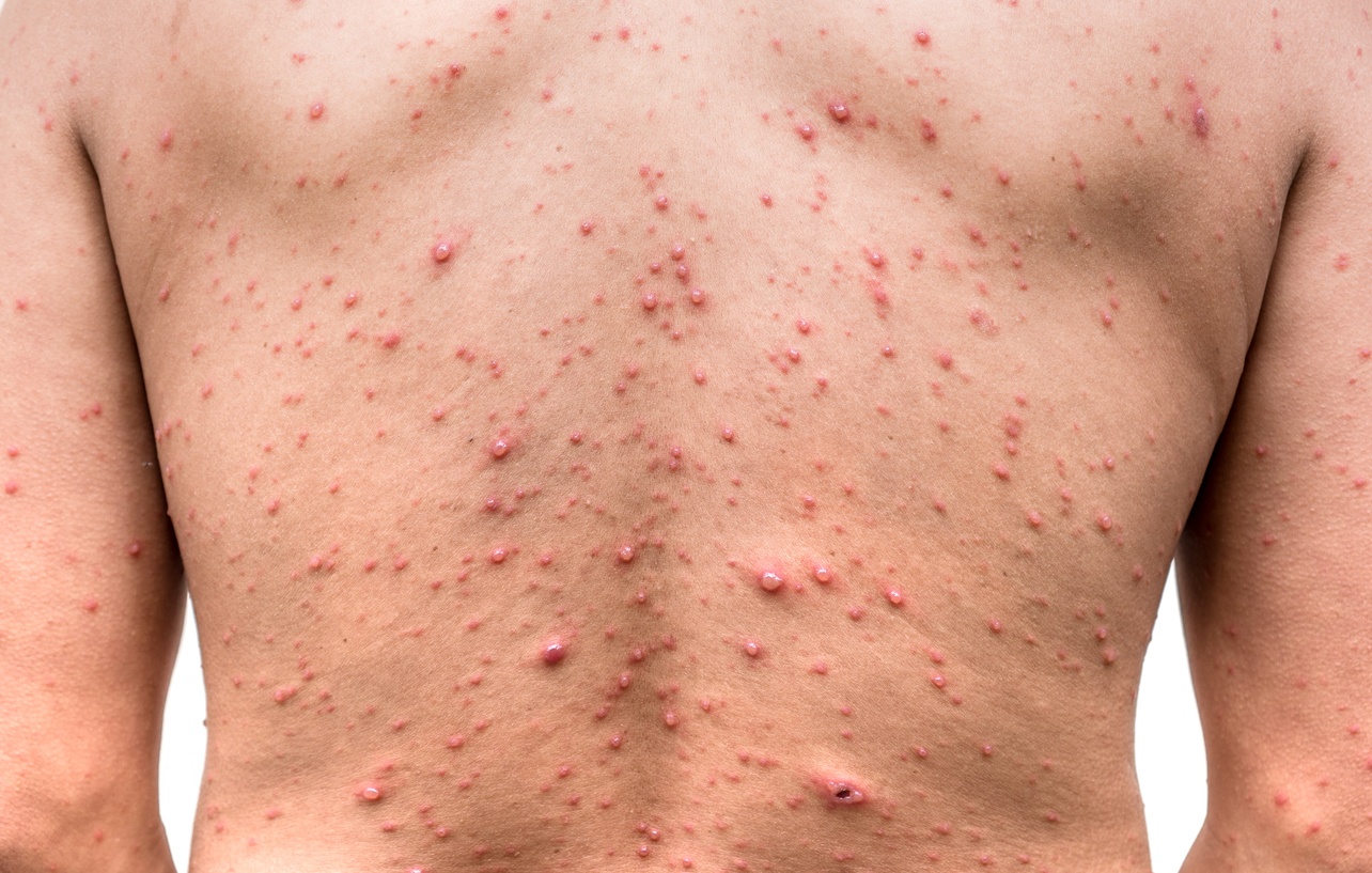 Hives vs Rash - What's the difference between them?