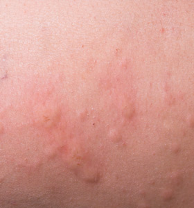 Hives (Urticaria)