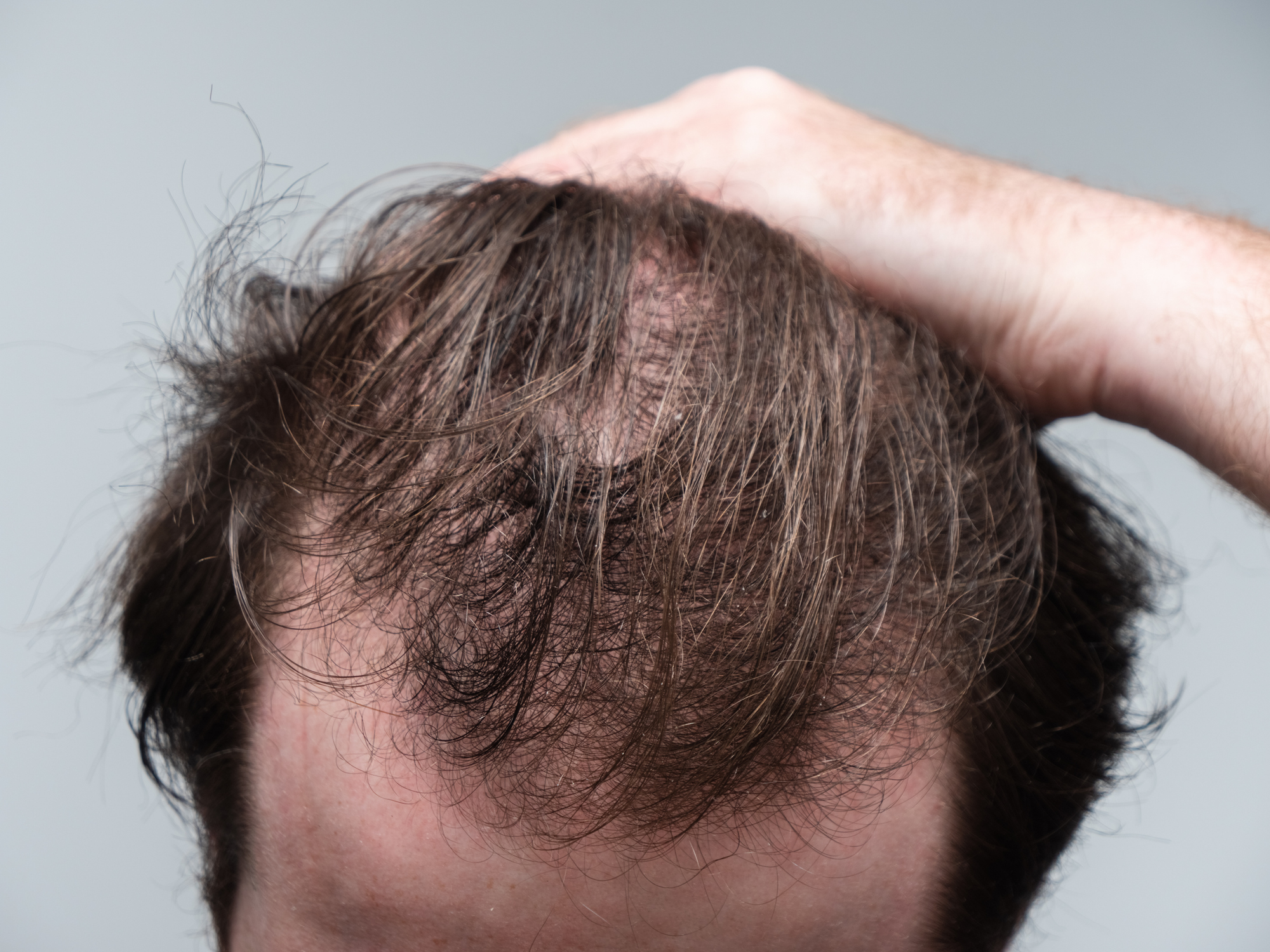New Test Determines if a Patient Will Respond to Oral Minoxidil |  MedEsthetics
