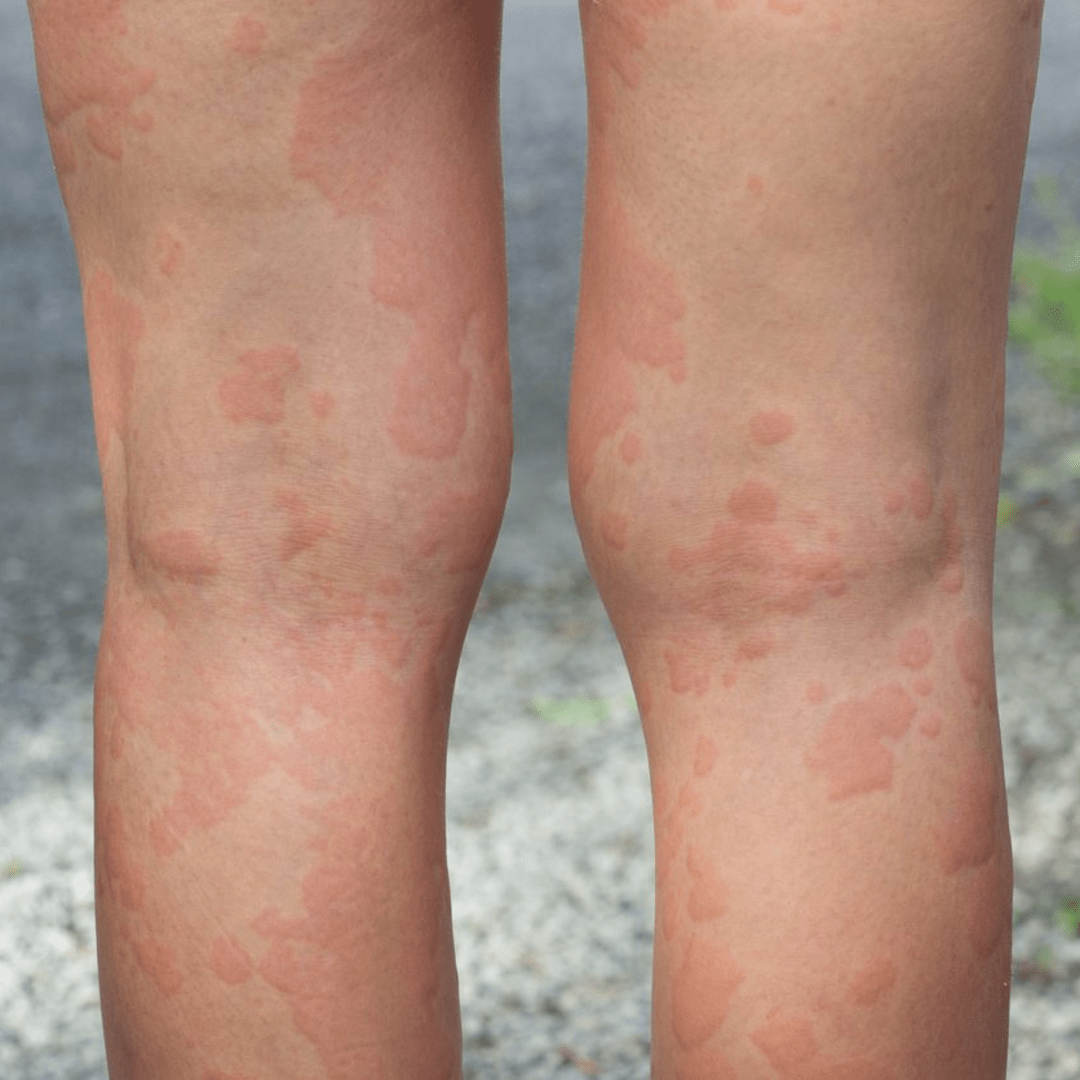 What causes a rash that moves to different parts of the body?