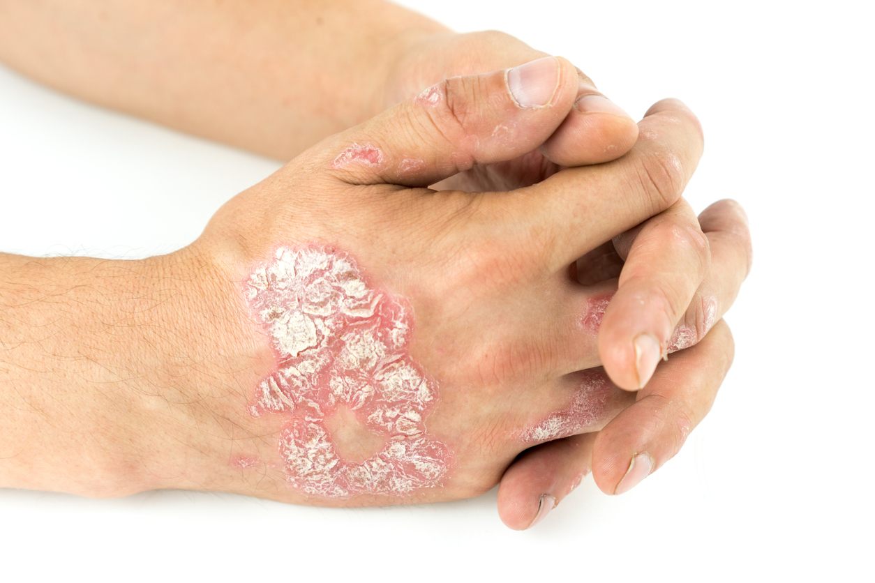 Can Eczema Ruin a Tattoo  My Experience  Advice Living with Eczema   Ezcema Skin Review