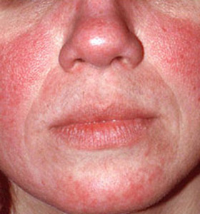 Rosacea