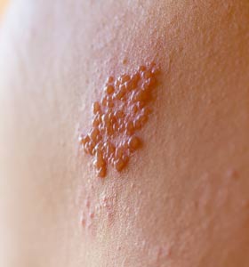 Shingles (Herpes Zoster)