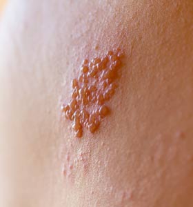 Dermatology Raleigh Nc