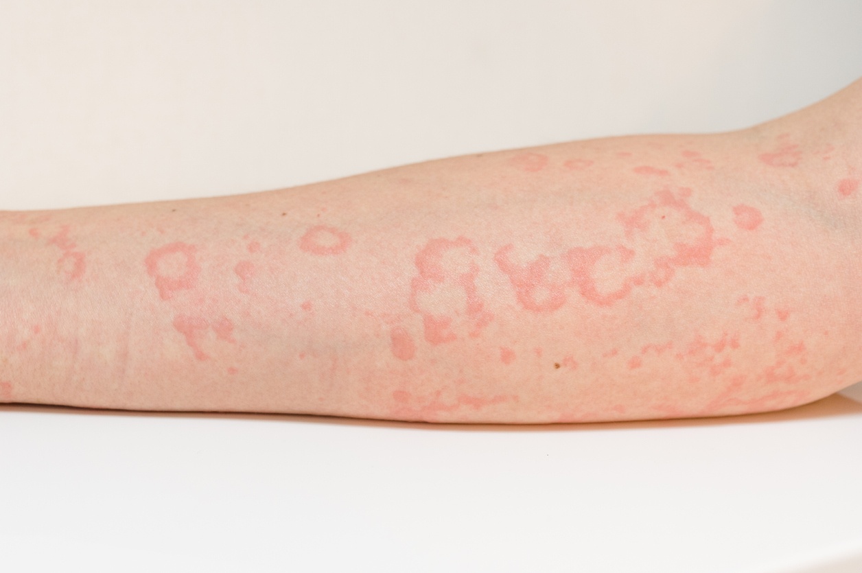 Hives Vs Rash Whats The Difference Between Them