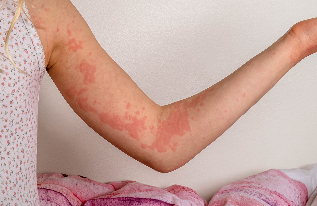 Rashes & spots (pictures) in toddlers, children & babies - NHS doctor  identified | MadeForMums