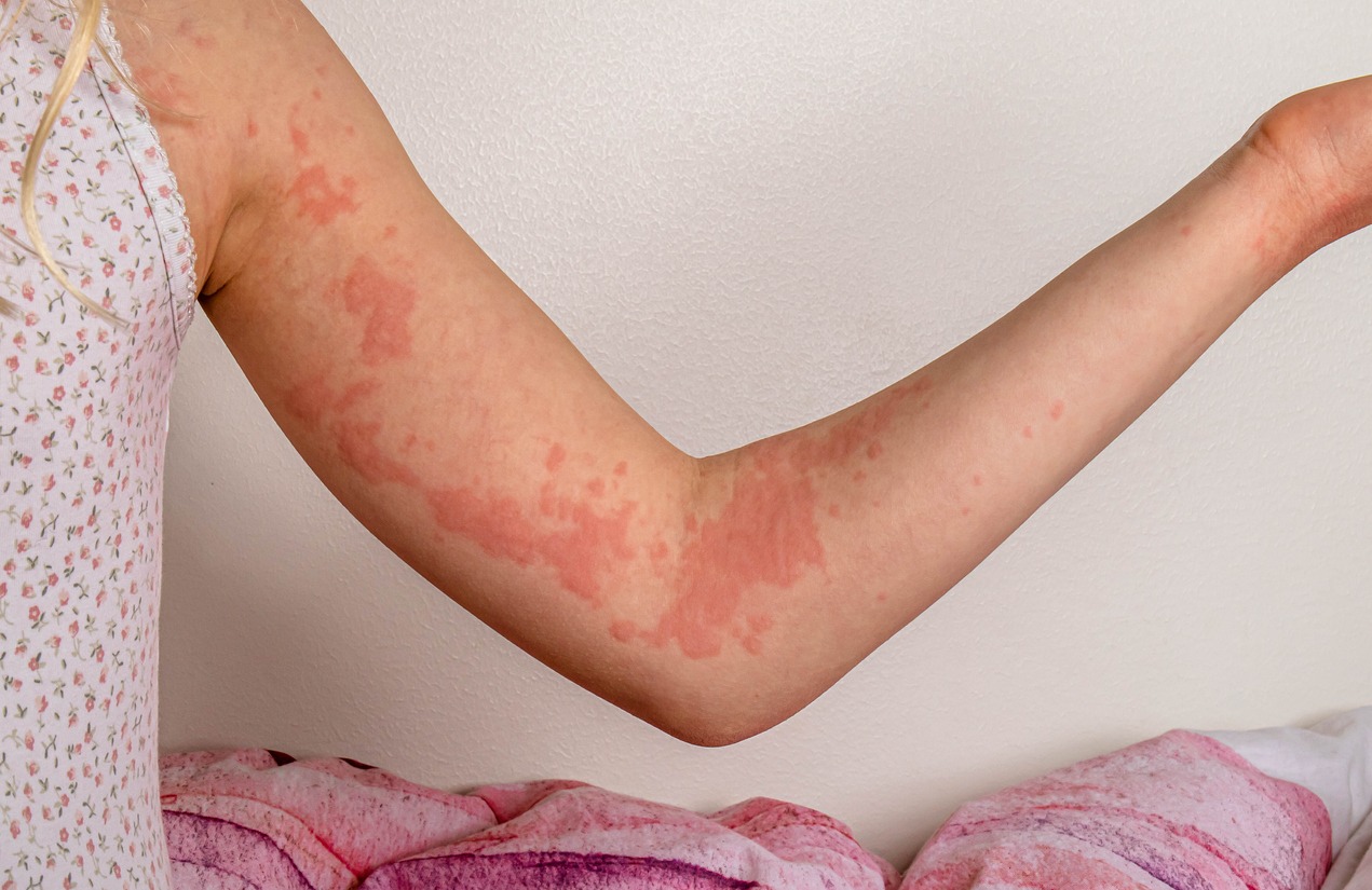 https://www.drugs.com/images/upload/urticaria-girl.64b60541aa239.jpg