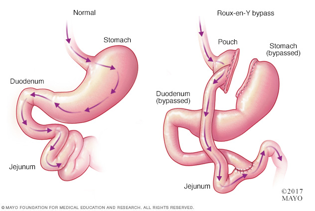 dumping-syndrome-disease-reference-guide-drugs