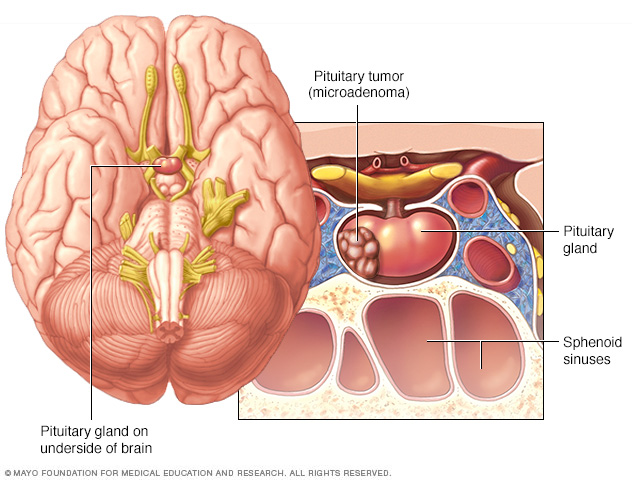 Oorzaken en symptomen van hypofysetumor