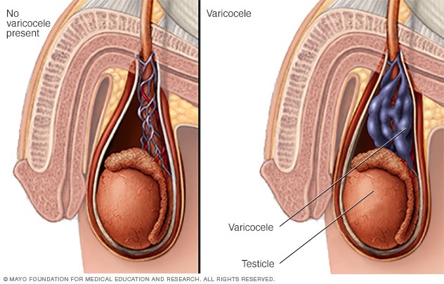 Two figures of testicles, one normal with no variocele present and one with variocele, inflamed veins surrounding the testicle.