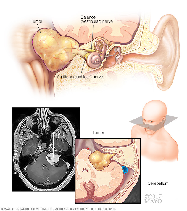 Neuroma akustik (vestibular schwannoma)