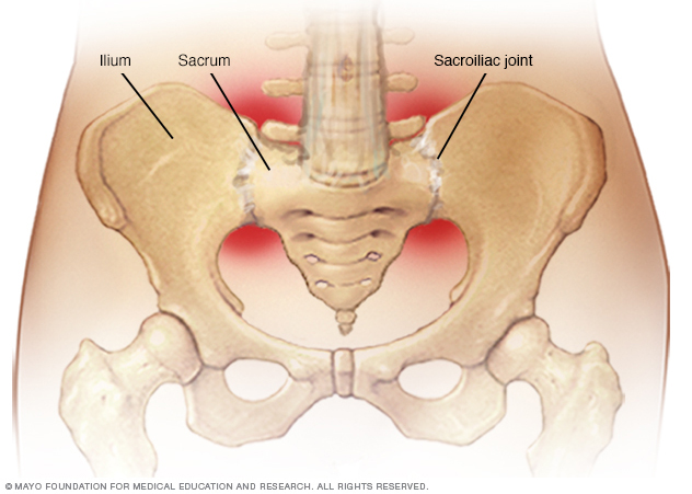 Sacroiliitis – Home Remedies vs. Therapies vs. Medical Treatment