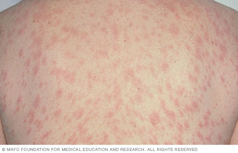 Pityriasis Rosea Disease Reference Guide Drugs Com