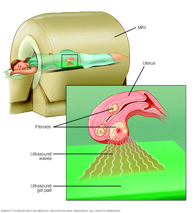 Chirurgie ultrasonore focalisée