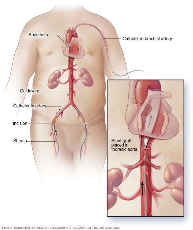 Endovaskulær reparasjon for thorax aortaaneurisme