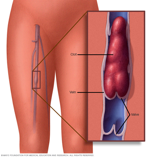 Darah beku dalam urat kaki