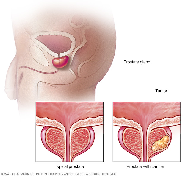 Příčiny a příznaky rakoviny prostaty