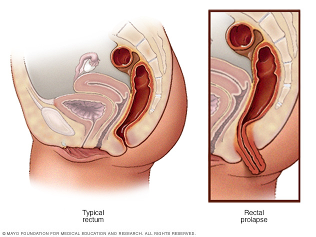 Prolapsus rectal