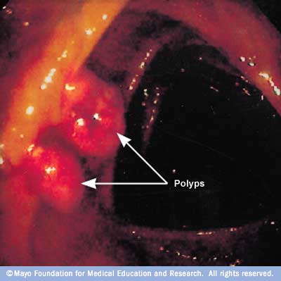 Malé polypy