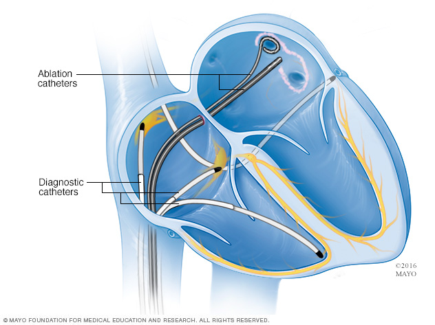 Cardiale ablatie