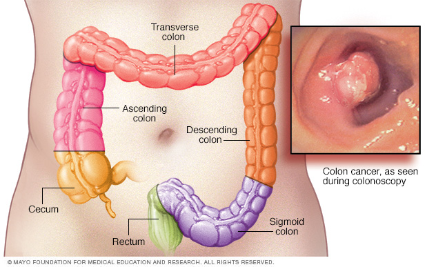 Causas y síntomas del cáncer de colon