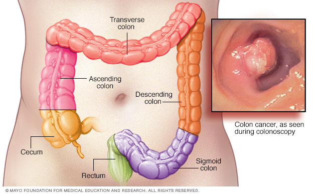 Cauze și simptome ale cancerului de colon