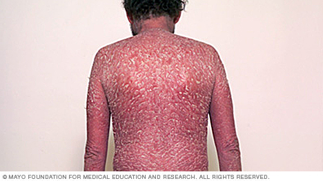 Erythrodermische psoriasis