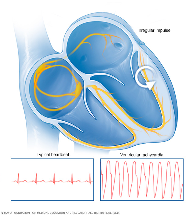 Ventricular tachycardia Disease Reference Guide - Drugs.com