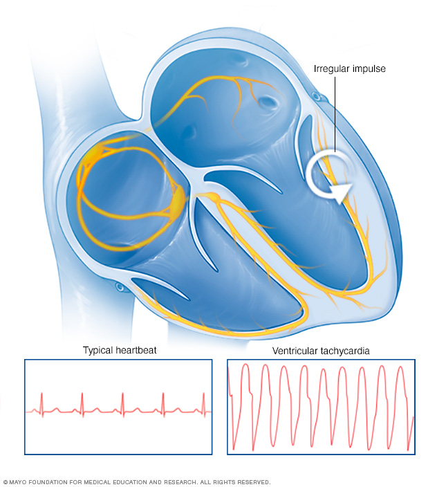 Ventricular tachycardia Disease Reference Guide - Drugs.com