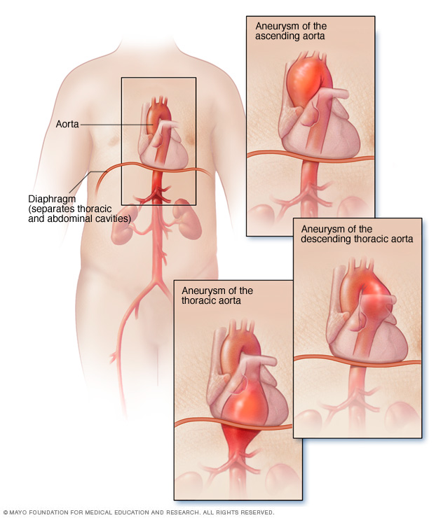 Causa y síntomas del aneurisma de la aorta torácica