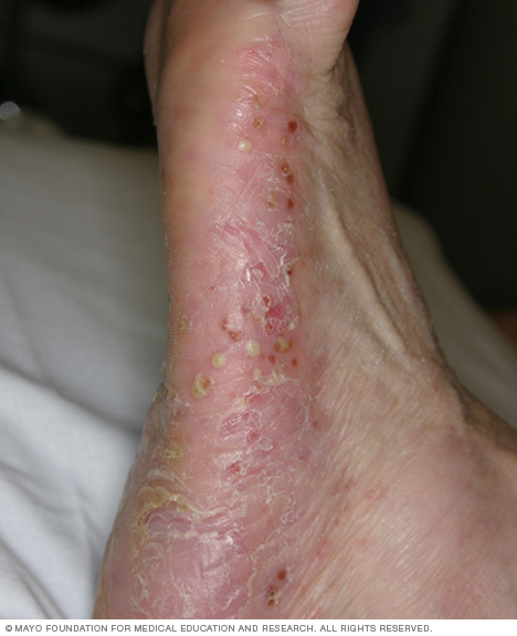 Pustulaarinen psoriaasi