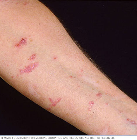 Lichen planus