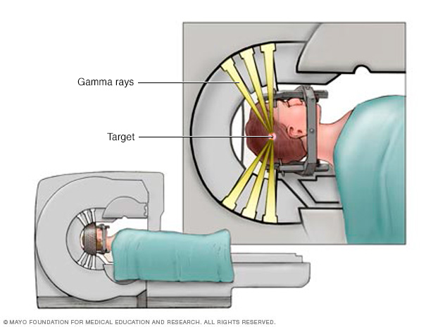 การกำหนดเป้าหมาย Gamma Knife