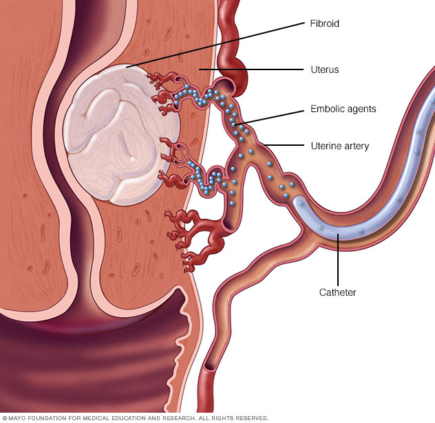 Embolización de la arteria uterina