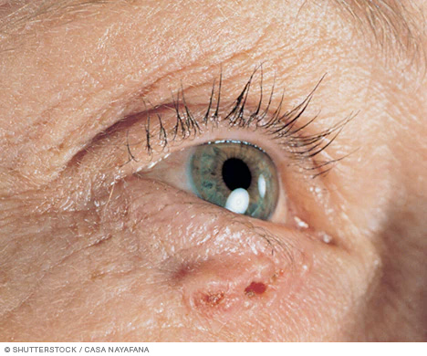 Basaalcelcarcinoom dat de huid van het onderste ooglid aantast