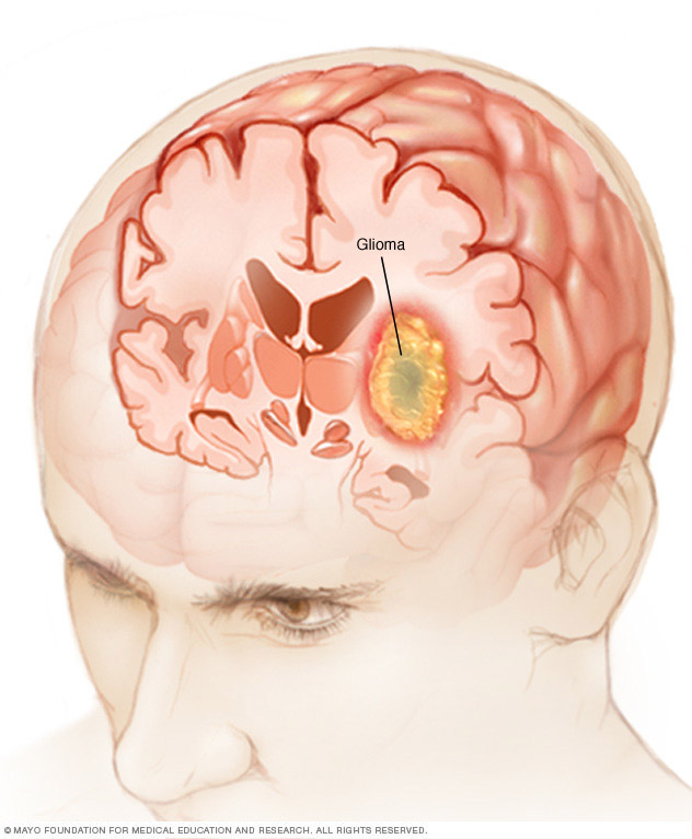 อาการและสาเหตุของ glioma