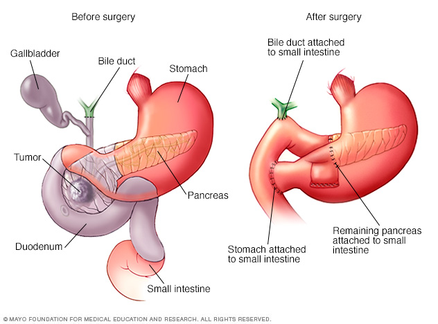 Chirurgie Whipple