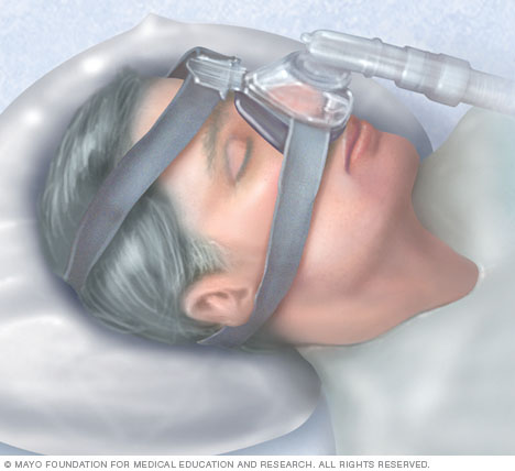 Presión positiva continua en las vías respiratorias (CPAP)
