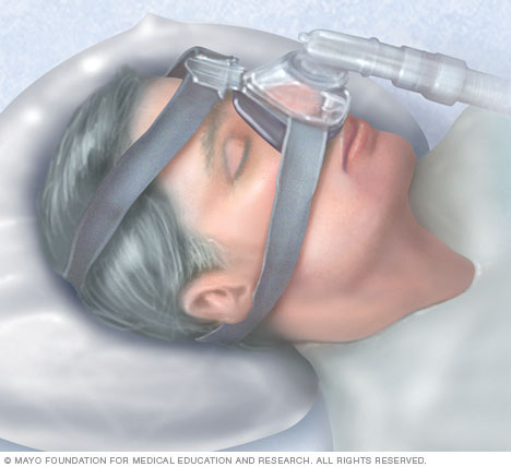 ความดันทางเดินหายใจบวกอย่างต่อเนื่อง (CPAP)