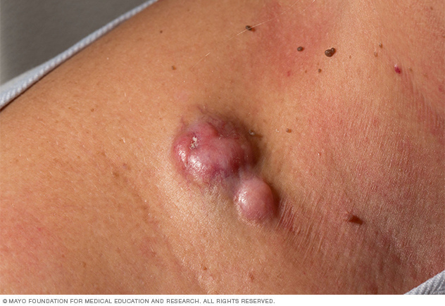 Protuberans Dermatofibrosarcoma