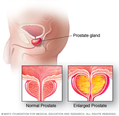 Hyperplasie bénigne de la prostate (HBP)