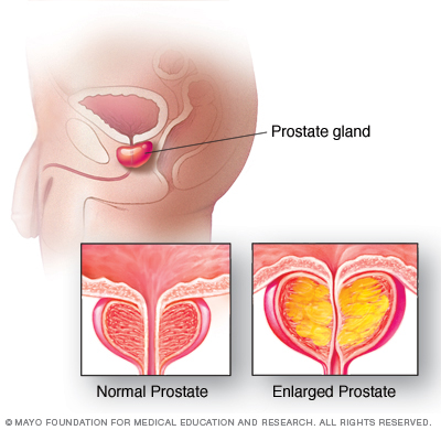 Benigní hyperplazie prostaty (BPH)