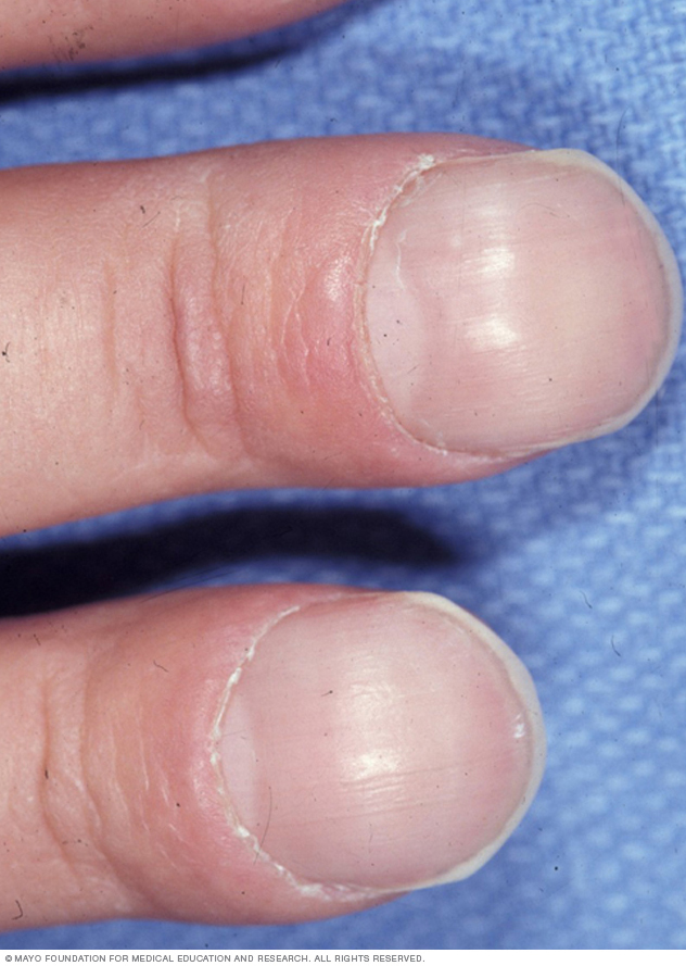 As pontas dos dedos se espalham e ficam mais redondas do que o normal.  Este sintoma está frequentemente associado a doenças cardíacas ou pulmonares.