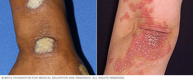 What does psoriasis look like?