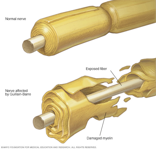 Guillain Barre Syndrome Disease Reference Guide Drugs guillain-barre-syndrome-disease-reference-guide-drugs