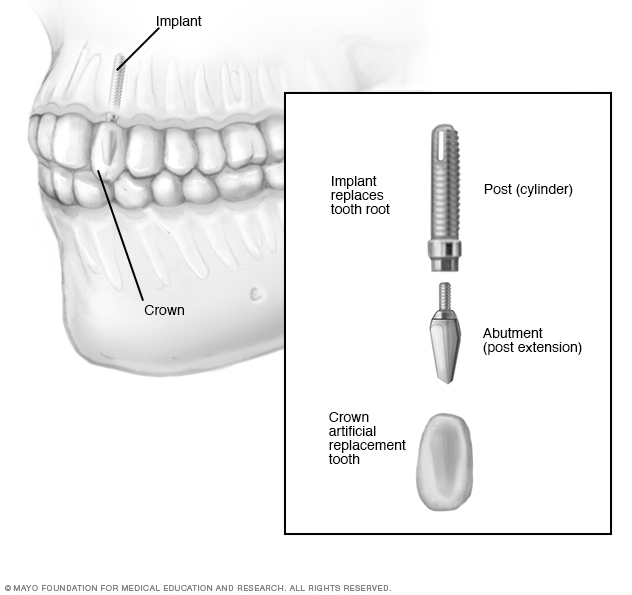 Effects xanax time recovery surgery side implant oral