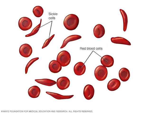 Sicklecellanemi